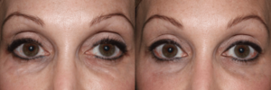 Lower eyelid fat grafting repair to remove lumps and bumps