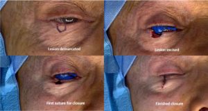 Eyelid Skin Cancer Removal