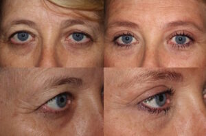 Brow lift, upper and lower blepharoplasty, and ptosis repair (left eye)