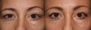 Eyelid paralysis reconstruction - MIOS procedure (left eye)