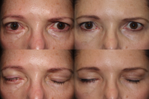 Eyelid paralysis surgery - MIOS procedure
