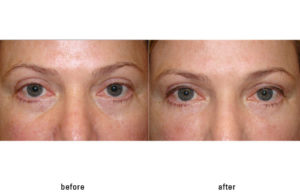 Fat Grafting to reduce under eye bags
