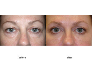 Fat Grafting to reduce under eye bags