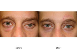 Prosthetic Eye (left) and cosmetic surgery to restore symmetry