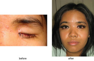 Eyelid and socket surgery with a prosthetic eye fitting