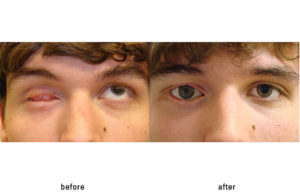 Reconstruction to the eyelids, socket, and fitted with a prosthesis