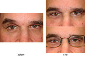 Prosthetic Eye (right) and cosmetic surgery to restore symmetry