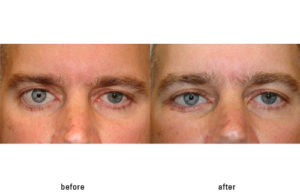 Prosthetic Eye and cosmetic eyelid surgery to fix eyelid position and shape