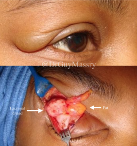Lacrimal gland repair