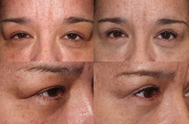Lacrimal Gland Repositioning with Upper Blepharoplasty