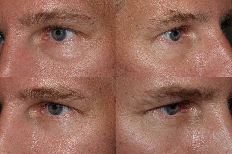 Lower Blepharoplasty with fat transpositioning