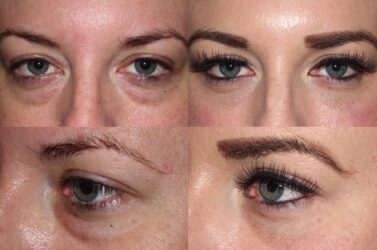 This patient underwent a Lower Blepharoplasty to get rid of her dark circles.