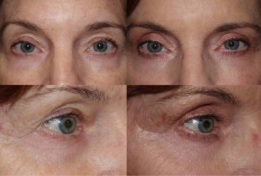 This patient underwent Upper Blepharoplasty with an Outer Brow Lift