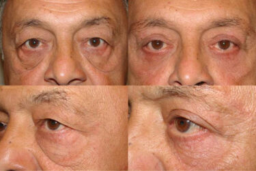 This patient underwent Upper Blepharoplasty, Outer Brow Lift, Festoon Excision and Canthoplasty