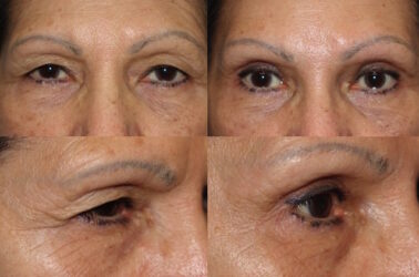 Brow lift with upper blepharoplasty Brow lift with upper blepharoplasty