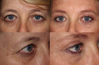 Brow lift, upper and lower blepharoplasty, and ptosis repair (left) Brow lift, upper and lower blepharoplasty, and ptosis repair (left)