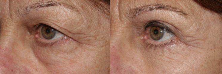Outer brow lift with upper and lower blepharoplasty Outer brow lift with upper and lower blepharoplasty