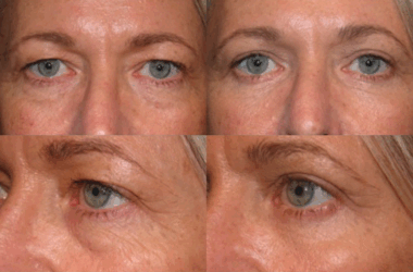 Customized Eyelid Rejuvenation - Upper and Lower Blepharoplasty Customized Eyelid Rejuvenation - Upper and Lower Blepharoplasty