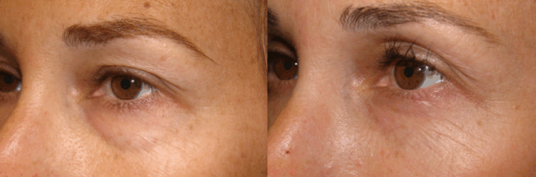 Customized cosmetic eyelid surgery - Lower and Upper Blepharoplasty Customized cosmetic eyelid surgery