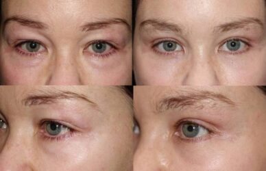 Upper and lower blepharoplasty with fat repositioning Upper and lower blepharoplasty with fat repositioning