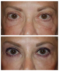 Festoons removal, lower blepharoplasty, and fillers Festoons removal, lower blepharoplasty, and fillers
