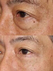Upper and lower blepharoplasty Upper and lower blepharoplasty