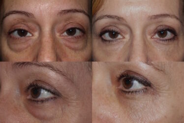 Lower blepharoplasty with fat repositioning Lower blepharoplasty with fat repositioning