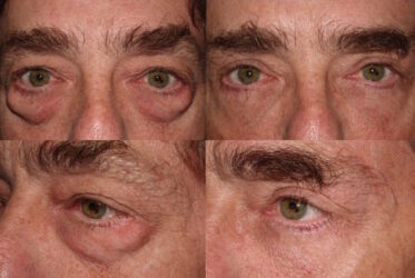 Festoons Removal, Lower and upper blepharoplasty and brow lift Lower and upper blepharoplasty and brow lift