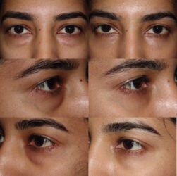Lower blepharoplasty with fat repositioning Lower blepharoplasty with fat repositioning
