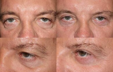 Upper and Lower Blepharoplasty Upper and Lower Blepharoplasty