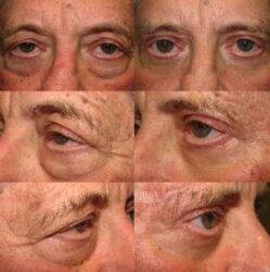 Male Upper and Lower Blepharoplasty, Browlift, Fat Transposition, Ptosis Repair, and Festoons Male Upper and Lower Blepharoplasty, Browlift, Fat Transposition, Ptosis Repair, and Festoons