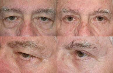 Upper and lower blepharoplasty Upper and lower blepharoplasty