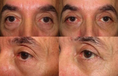 Lower Lid Blepharoplasty with Fat Repositioning & Fat Graft to Cheeks Lower Lid Blepharoplasty with Fat Repositioning & Fat Graft to Cheeks