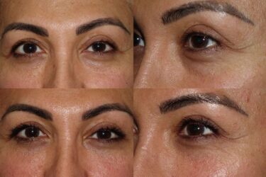 Lower Blepharoplasty with fat grafting and fat repositioning Lower Blepharoplasty with fat grafting and fat repositioning