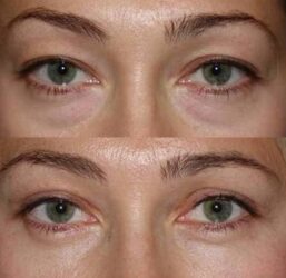 Lower blepharoplasty with fat repositioning Lower blepharoplasty with fat repositioning