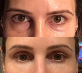 Lower Blepharoplasty with fat repositioning Lower Blepharoplasty with fat repositioning