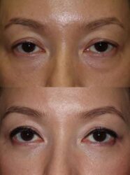 Lower blepharoplasty with fat repositioning Lower blepharoplasty with fat repositioning