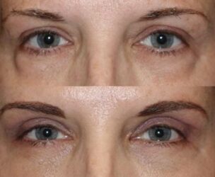 Upper and lower blepharoplasty with fat repositioning Upper and lower blepharoplasty with fat repositioning