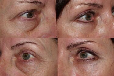 Upper and Lower Blepharoplasty Upper and Lower Blepharoplasty