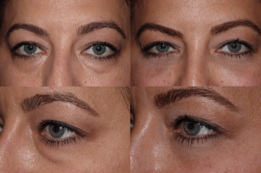 Lower Blepharoplasty - Under eye bag rejuvenation surgery Lower Blepharoplasty - Under eye bag rejuvenation surgery