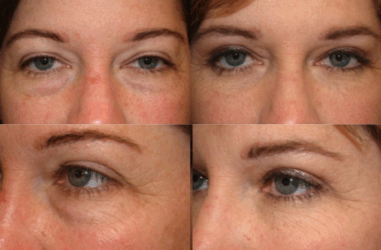 Lower Blepharoplasty - Under eye bag surgery Lower Blepharoplasty - Under eye bag surgery