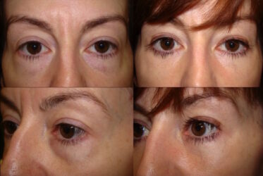 Lower Blepharoplasty - Under eye bag surgery Lower Blepharoplasty - Under eye bag surgery