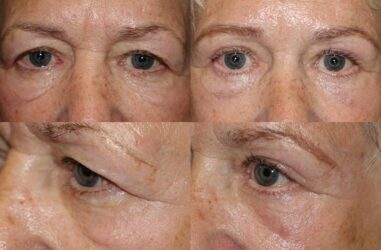 Upper and lower blepharoplasty Upper and lower blepharoplasty