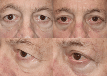 Male upper and lower Blepharoplasty, Festoons Removal Male upper and lower Blepharoplasty, Festoons