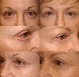 This woman had pulled down (retracted) and turned-out ectropic lower lids after cosmetic surgery elsewhere. After lower lid lift, cheek lift, skin graft, and canthoplasty she was much improved. This example shows how patients can often be improved but never made perfect (depending on the degree of the presenting problem). Revisional lower lid lift, cheek lift, skin graft, and canthoplasty