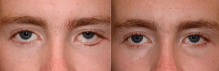 This young man had a pulled down left lower lid after trauma (fracture of bones around the eyes). This occurred because of the surgery to fix his fracture and not the fracture itself. After revisional surgery (release of the scar, canthoplasty, and lid elevation) he is much better at only ONE MONTH AFTER SURGERY. Revisional Surgery - release of the scar, canthoplasty, and lid elevation post physical trauma