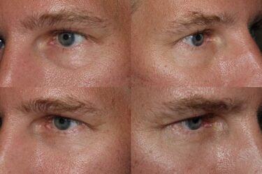 Lower Blepharoplasty with fat transpositioning Lower Blepharoplasty with fat transpositioning