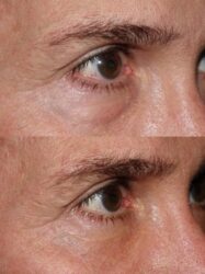 Lower lid rejuvenation - Lower blepharoplasty with fat transpositioning - Male Blepharoplasty Lower blepharoplasty with fat transpositioning