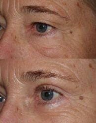 Upper and Lower Blepharoplasty with outer brow lift Upper and Lower Blepharoplasty with outer brow lift