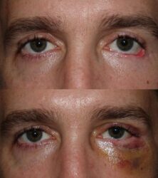 Lower Lid Reconstruction Surgery with skin flap, canthoplasty, lid margin rotation, and mid-face lift Lower Lid Reconstruction Surgery with skin flap, canthoplasty, lid margin rotation, and mid-face lift